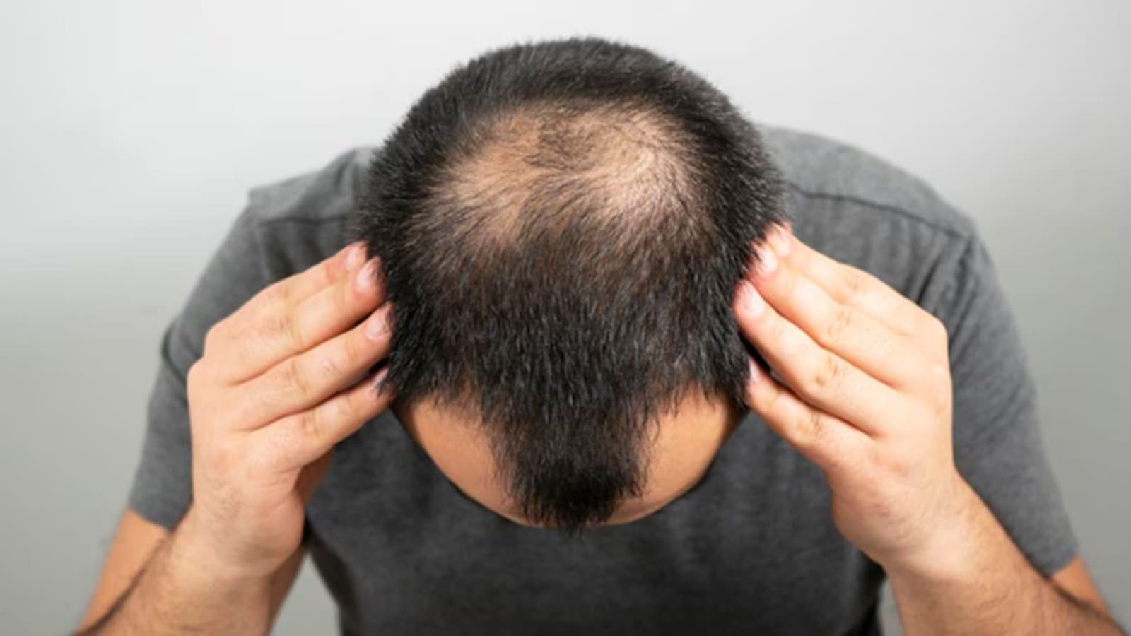 After 3 failed hair transplants, hair regrows in 44-year-old: How to restore hair after botched-up procedures