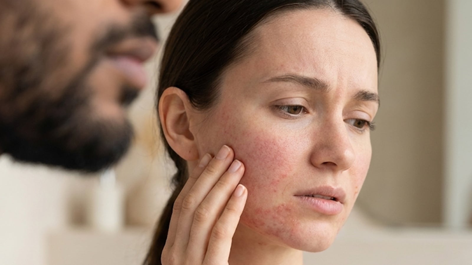 &lsquo;Have you ever experienced beard burn?&rsquo;: Doctor explains why a kiss can cause redness and itching; a dermatologist verifies